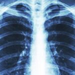 تشخیص-بیماری-انسداد-ریوی-مزمن-COPD